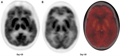 Case report: Treatment of parkinsonism secondary to ciltacabtagene autoleucel using a combination dopaminergic regimen